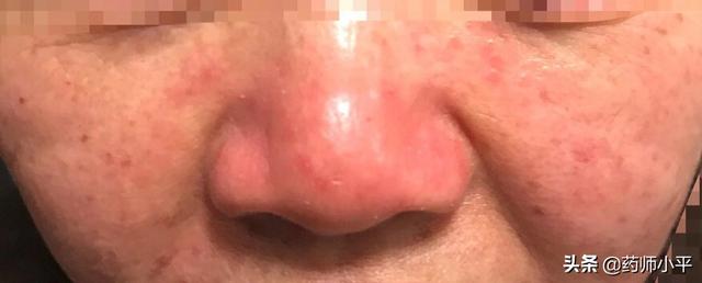 面部發(fā)紅癢癢、反復(fù)過(guò)敏，可能是在提醒做這一件事情，該清除螨了