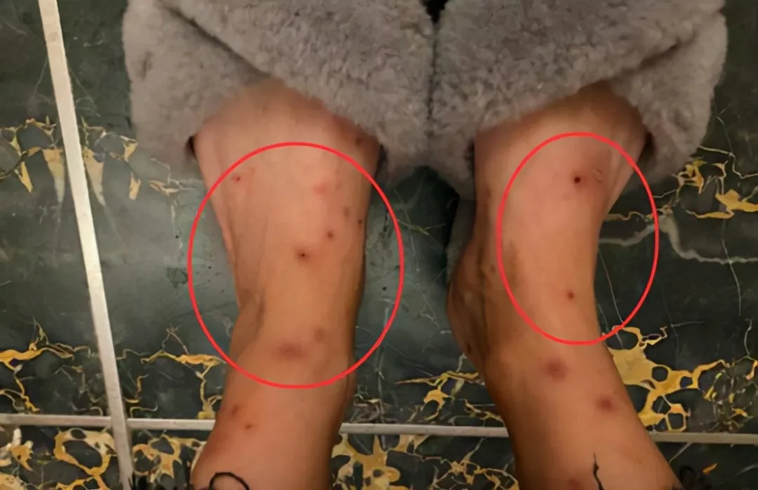 一小區(qū)跳蚤泛濫！跳蚤究竟哪來的？